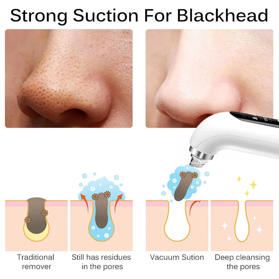 ⚡️FLASH SALE 50% OFF⚡️- Vacuum Blackhead Remover